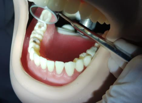 PRÁTICA LABORATORIAL COM SIMULAÇAO DE DENTINA CARIADA
